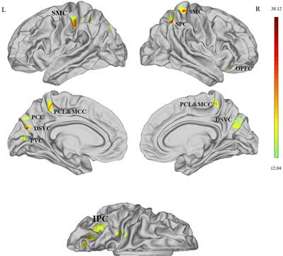 Cortical Thickness Alterations in Patients With Tinnitus Before and After Sound Therapy: A Surface-Based Morphometry Study